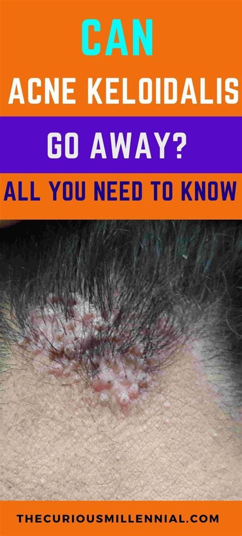 Can Acne Keloidalis Go Away What You Need To Know