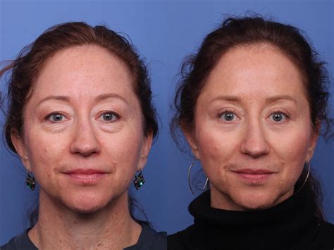 Blepharoplasty Before And After Pictures Case 465 Scottsdale Az Hobgood Facial Plastic