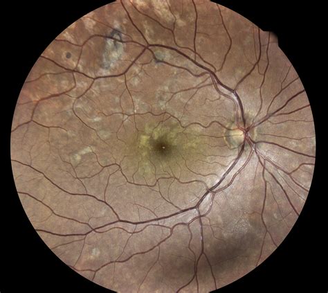 How to differentiate choroidal melanoma is the most common primary intraocular malignancy in adults. APMPPE (Eidon)