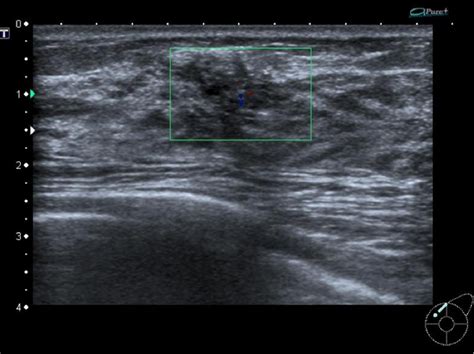 Figure 2 From Ultrasound Of Non Neoplastic Breast Lesions With