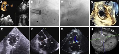 Transcatheter Tricuspid Valve Replacement For Treating Severe Tricuspid