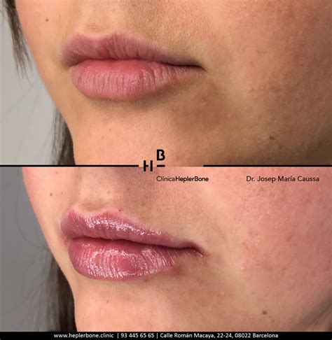 labios con ácido hialurónico clínica hb