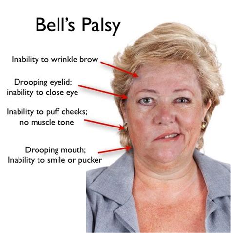 What Is Bells Palsy Bells Palsy Facial Nerve Medical Knowledge