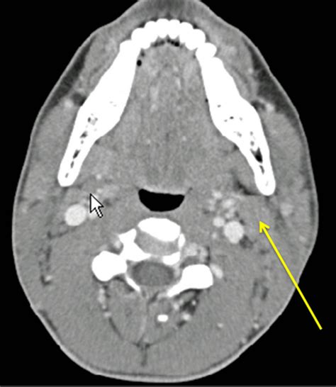 Atypical Cystic Parotid Gland Acinic Cell Carcinoma In A Child