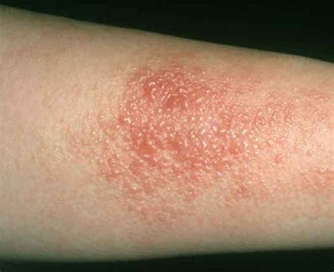 Contact Dermatitis Dermatology Conditions And Treatments