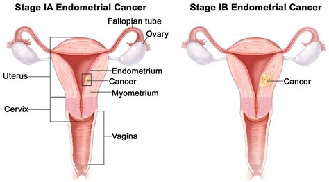 Endometrial Cancer Causes Early Signs Symptoms Treatment