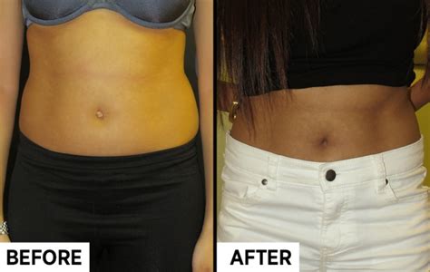 The Latest Plastic Surgery Trend Involves Your Belly Button