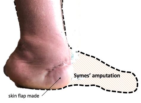 Your Foot After Amputation Consulting Footpain