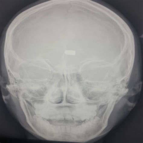 The Skull X Ray Antero Posterior B And Lateral Viewsa Showing A