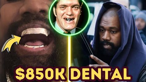 Kanye Wests Jaw Dropping Dental Journey 850k Titanium Dentures