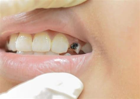 What Is The Broken Tooth Extraction Procedure Like Somos Camelback