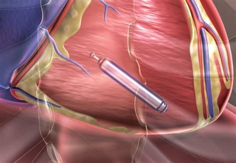 Leadless Pacemaker Delivers Reduced Rates Of Traditional Pacemaker