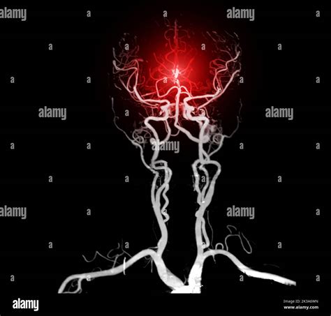 Cta Brain Or Ct Angiography Of The Brain 3d Rendering Image For