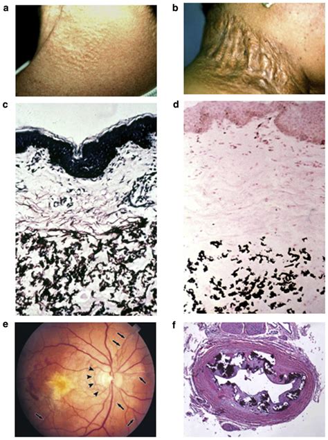 Clinical Features And Histopathology Of Ectopic Mineralization In