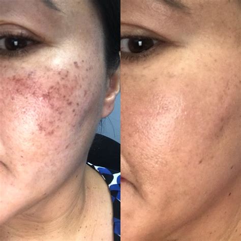 Managing Acne Scars With Sublative Rejuvenation Tarzana And Encino