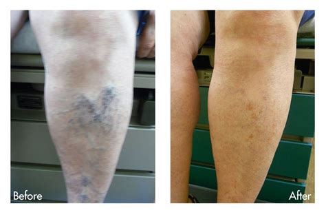 Spider Vein Treatment Best Solutions And Options For Patients