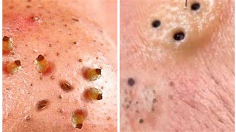 Black Head Removal From Infected Face Oddly Satisfying Blackhead