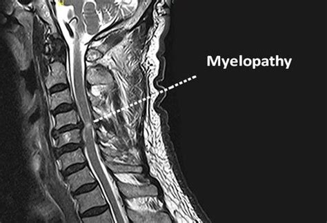 Numbness After Accident Myelopathy Myelopathy Is Nerve Damage