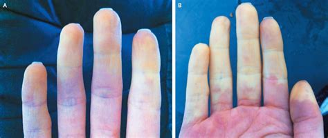 Raynaud Syndrome Medihelp