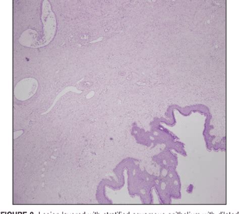 Giant Fibroepithelial Polyp Of Vulva Scienti C Letter Semantic Scholar