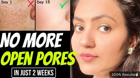 15 Days Skincare Challenge 💕 Get Rid Of Open Pores Naturally In Just