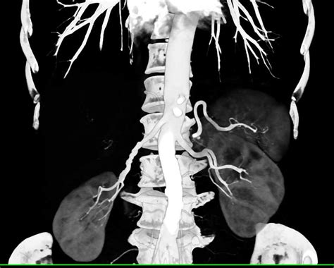 Fibromuscular Dysplasia Fmd Of The Right Renal Artery Vascular Case
