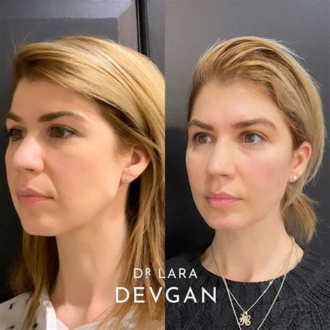 Dr Lara Devgan Md Mph Facs On Instagram “the Subtle Beauty Of A