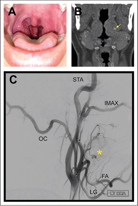 Figure 1 From Tonsillar Artery Pseudoaneurysm In A Patient With