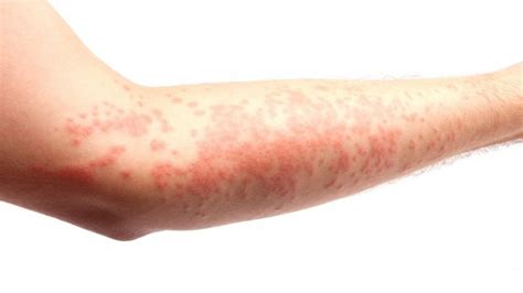 What Is Hives And Its Symptoms And Treatment Health Clinic