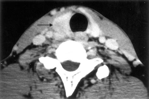 Ct And Mr Imaging Findings Associated With Subacute Thyroiditis