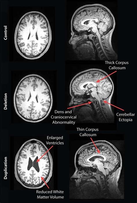Mri Reveals Striking Brain Differences In People With Genetics Autism