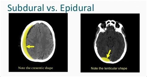 Subdural Hematoma Vs Epidural Hematoma XRAY Google Search Subdural