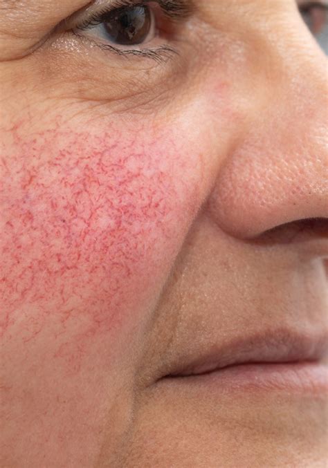 Facial Veins And Redness The Laser And Skin Clinic