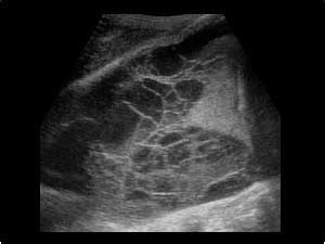 When you have a pleural effusion, fluid builds. Thorax | 8.2 Pleural space : Case 8.2.1 Effusion and ...