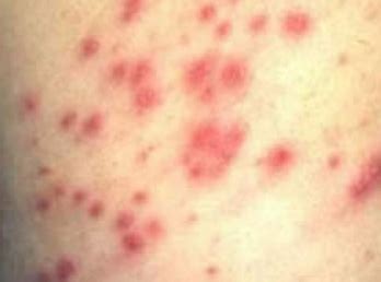 A rash is a change in the skin that can result in bumpy, blotchy, or scaly patches. Hot Tub Rash | Netherlands| PDF | PPT| Case Reports ...
