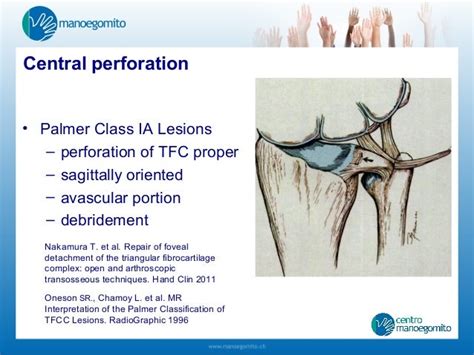 Acute Triangular Fibrocartilage Complex Injuries Treatment And Managem