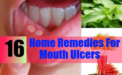 Though mouth ulcer is harmless, it may cause extreme discomfort to the mouth and make it difficult for some people to eat, drink, and brush their teeth. 16 Home Remedies For Mouth Ulcers - Natural Treatments ...