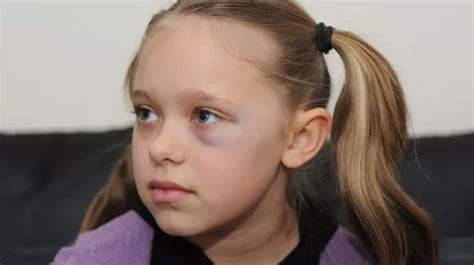 Girl 9 Left With Black Eye After Stranger Hit Her So Hard Her Earring