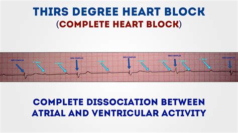 Clinical and electrocardiographic features of complete heart block after blunt cardiac injury: Third degree (complete heart block) | Geeky Medics
