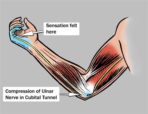 Beantown Physio Pt Tip Of The Month Archive Cubital Tunnel Syndrome