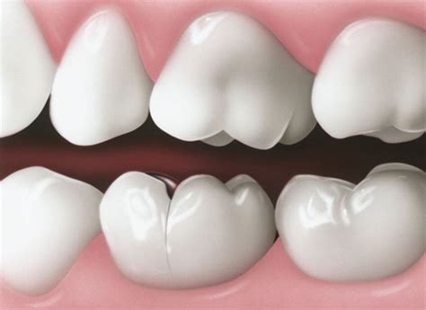 Your Best Options For Repairing A Cracked Tooth Your Dental Health