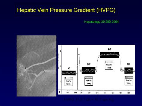 Hepatic Vein Pressure Gradient Hvpg
