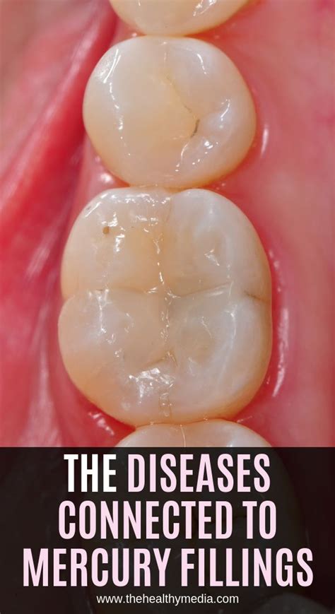 Amalgam fillings are not often used now, as there are newer and safer alternatives. The Diseases Connected to Mercury Fillings | Integrative ...