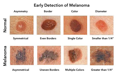 Melanoma Skin Cancer Types Stages Grades Signs Symptoms Risk