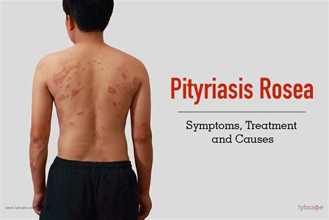 Pityriasis Rosea Rash On Back