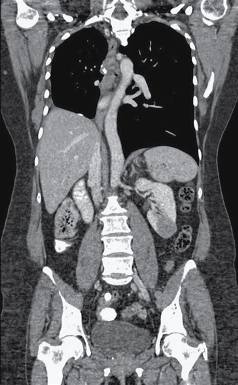 Contrast Enhanced Computed Tomography In Arterial A And Venous B