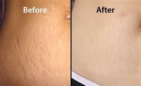 Stretch Marks Removal Treatment Via Laser Jaipur Skincity