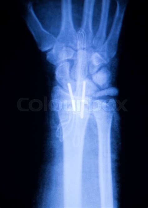 Forearm Orthopedic Implant Xray Scan Stock Image Colourbox