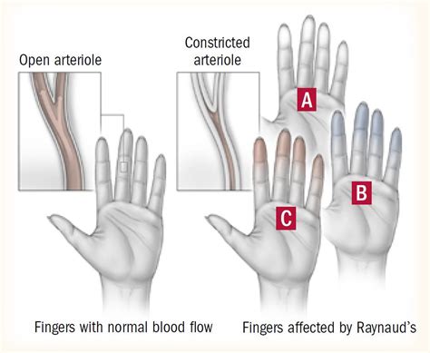 Raynauds Phenomenon Guide Causes Symptoms And Treatment Options