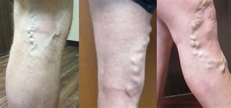 The Truth About Varicose Veins That Everyone Needs To Know